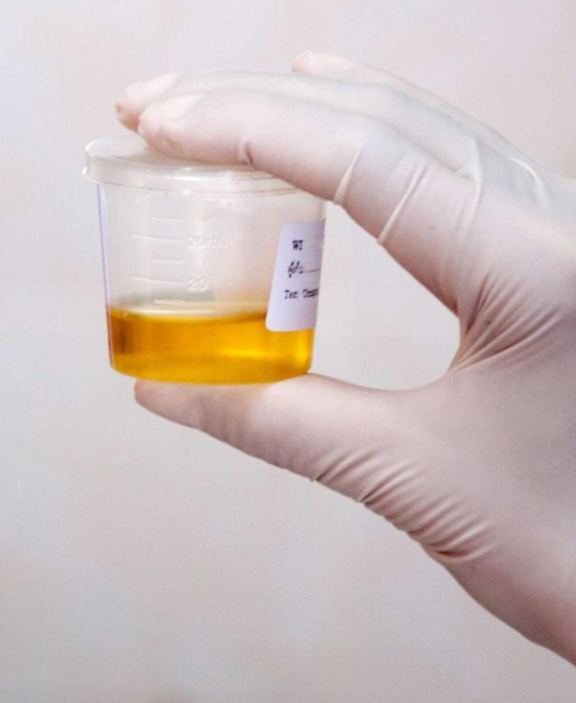 Urinalysis