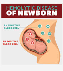 HAEMOLYTIC DISEASE OF NEWBORN